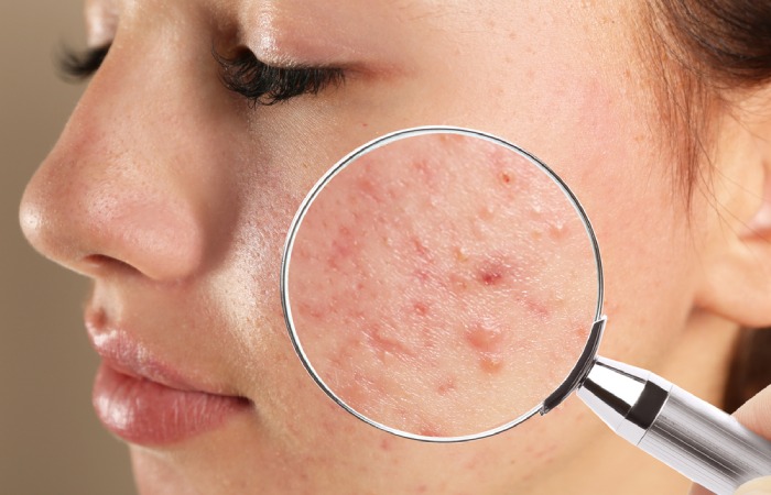 Different types of acne and how to treat them