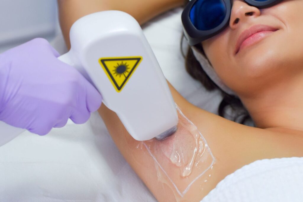 laser hair removal