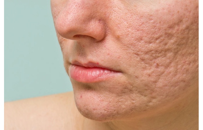 Blemish prone skin common skin